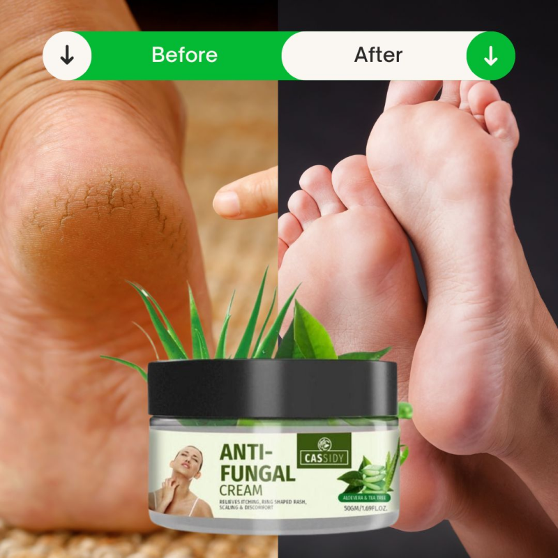 Cassidy anti fungal cream